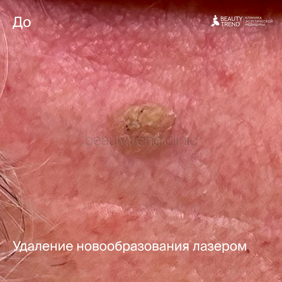 Удаление новообразований SmartXide - до 1